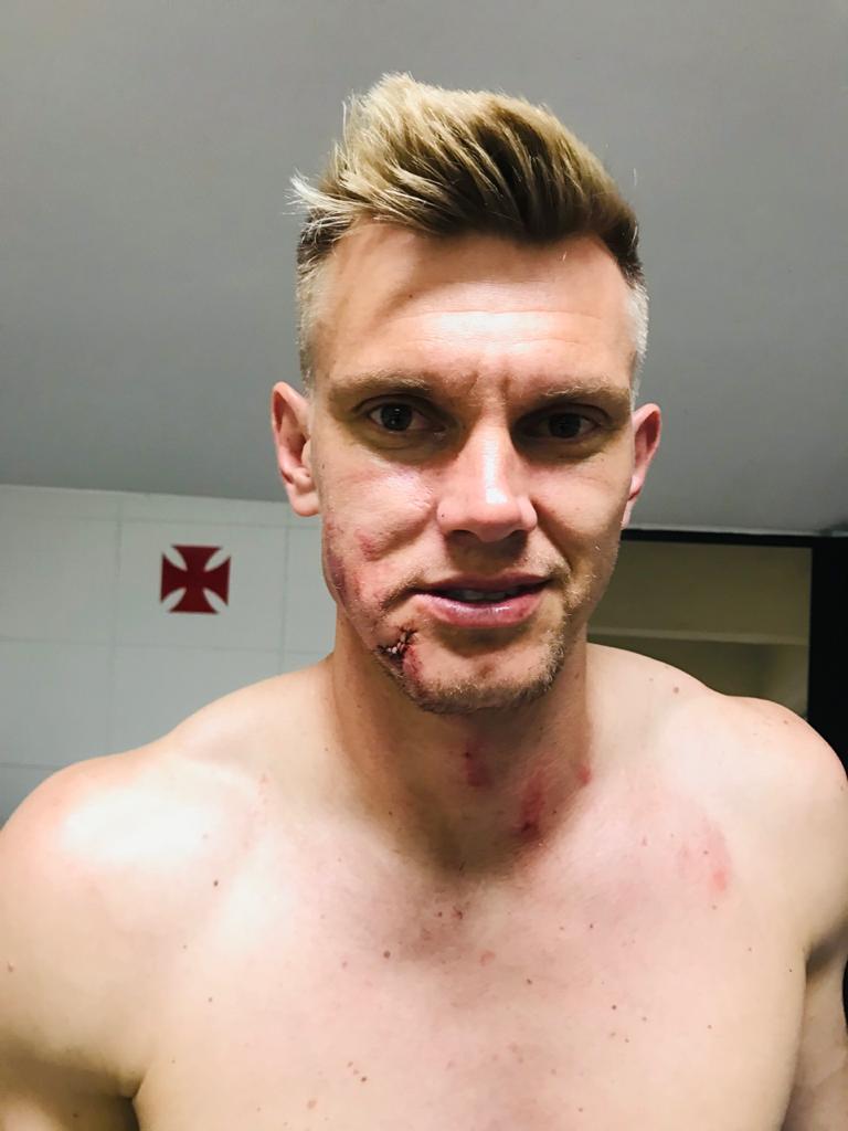 Douglas Friedrich sofreu um corte no rosto e precisou levar cinco pontos